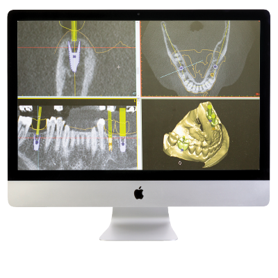 richard-gagne-digital-dental-implant-planning Computerized dental implant planning and surgery