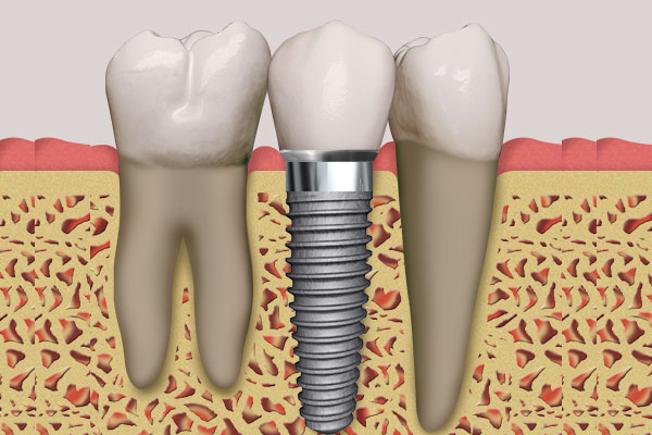 Implant_crown_600_x_400 Dental implant